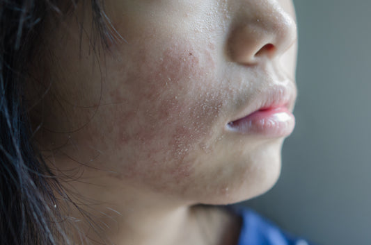 アトピー性皮膚炎で顔が腫れる。瞼も腫れる。